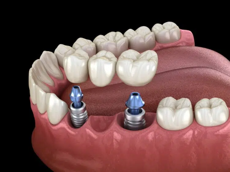 Dental Implant Bridges