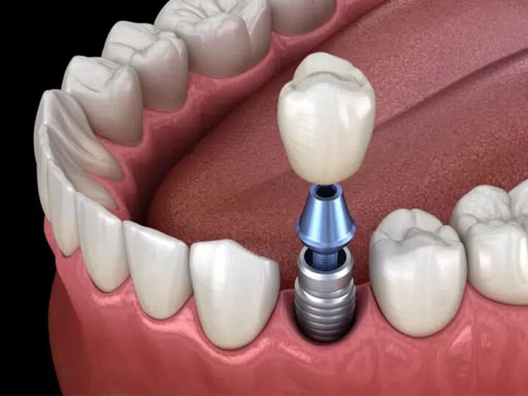 Dental Implant Crowns